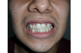 Borde a borde 1