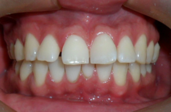 Protrusion12A